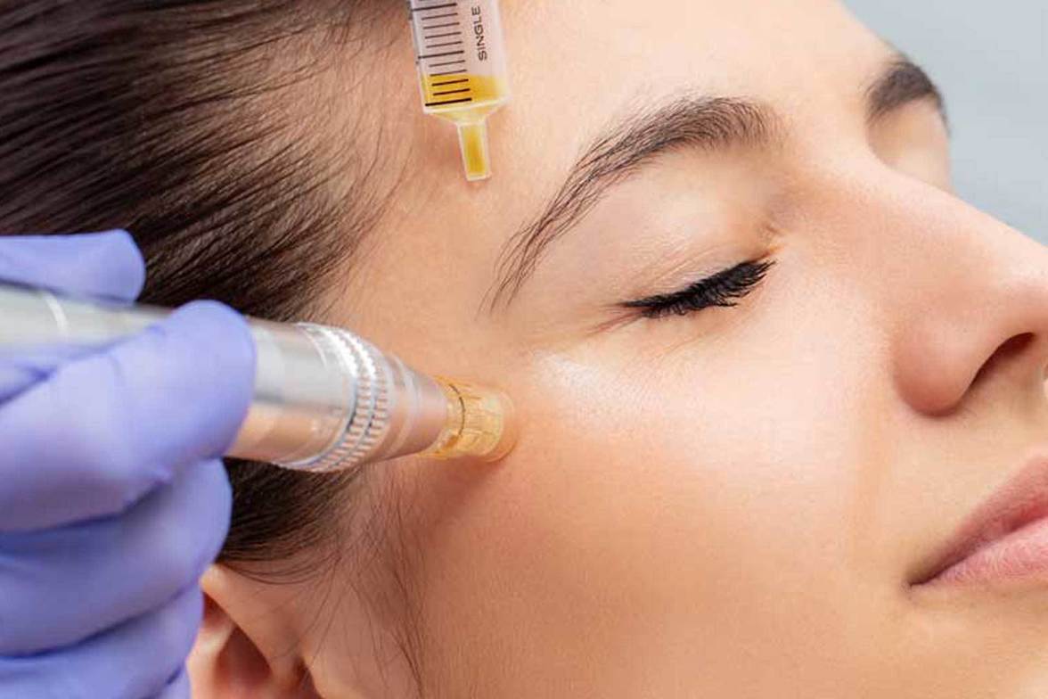 PRP Microneedling: When to Wash Your Face