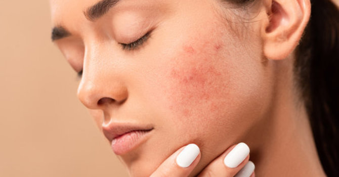 Does Hyaluronic Acid Help Acne?  image