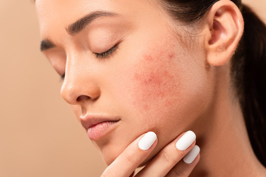 Does Hyaluronic Acid Help Acne? 