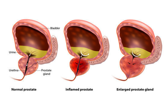 Ozone Therapy for Prostate Health