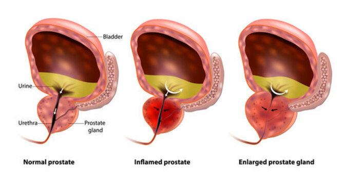 Ozone Therapy for Prostate Health image