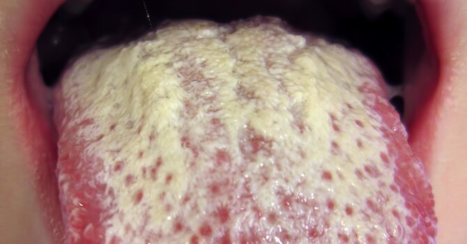 Ozone Therapy for Yeast Infections image