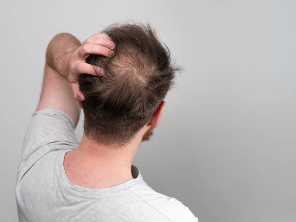Does TRT Cause Hair Loss?