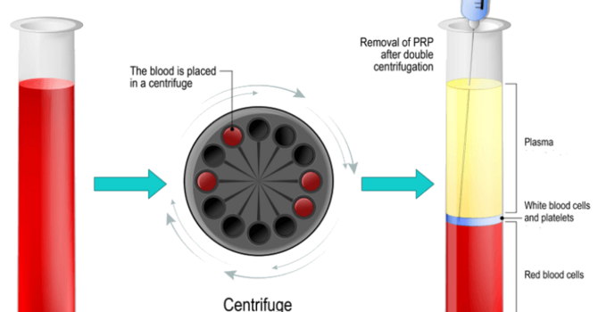 Why No Caffeine After PRP? image
