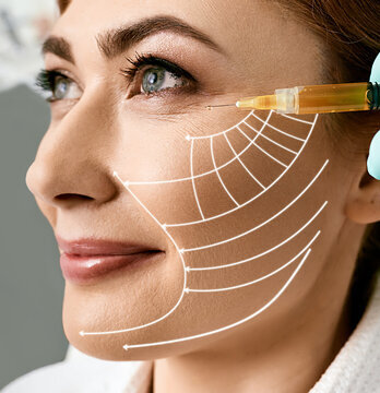 How Many Sessions of PRP Are Needed for the Face?