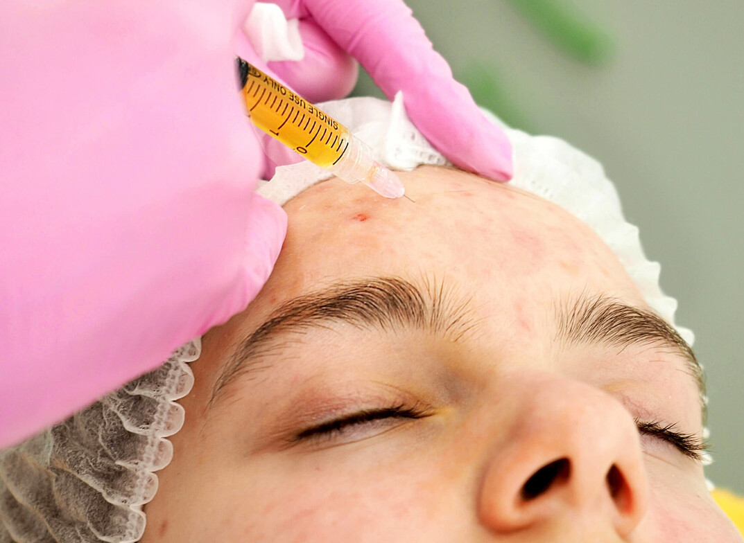 Does PRP Change Face Shape?