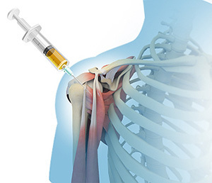 PRP Injection Shoulder Recovery Time