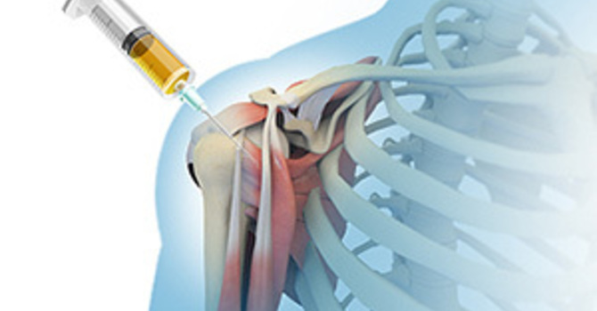 PRP Injection Shoulder Recovery Time image