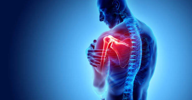 PRP For Shoulder Labrum Tear